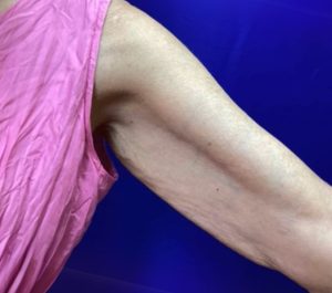 After 1 month Sofwave arms treatment by Adean Kingston