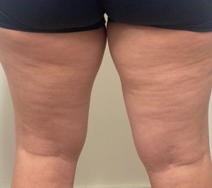 After 1 month Sofwave cellulite treatment at GreatSkin Inc