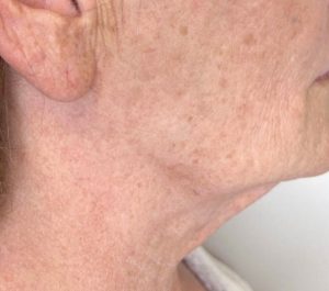 After 1 month Sofwave submental procedure at Forever Young