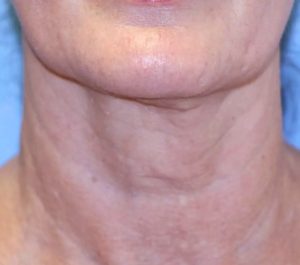 After 10 months Sofwave neck procedure by Craig Colville – Bella Vista
