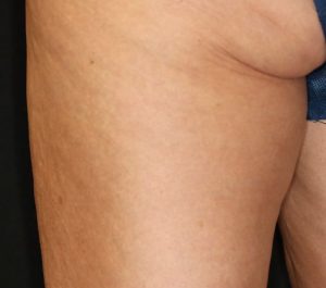 After 12 weeks Sofwave cellulite treatment by Dr. Eric Bernstein