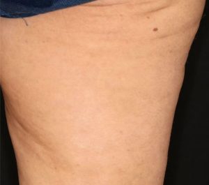 After 12 weeks Sofwave cellulite treatment by Dr. Suzanne Kilmer