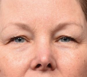 After 12 weeks Sofwave eyes treatment by Dr. Girish Munavalli