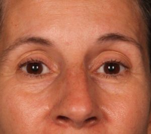 After 12 weeks Sofwave eyes treatment by Dr. Arielle Kauvar