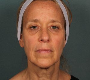After 12 weeks Sofwave face treatment by Dr. Roy Geronemus