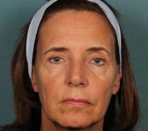 After 12 weeks Sofwave face treatment by Dr. Roy Geronemus