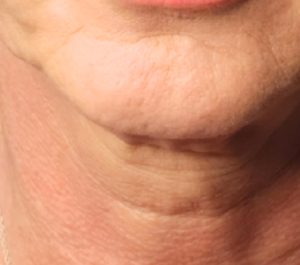 After 12 weeks Sofwave neck procedure at Glistening Beauty Sarah O'Donnell