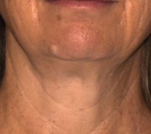 After 12 weeks Sofwave neck procedure by Suzanne Kilmer