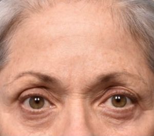 After 14 weeks Sofwave eyes treatment by Gily Munavalli
