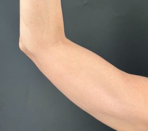 After 2 months Sofwave arms treatment at Aestheticare Medspa