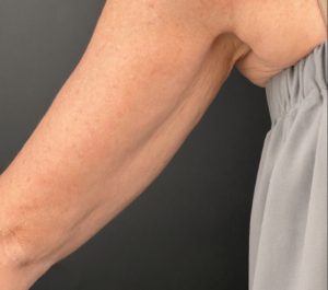 After 2 months Sofwave arms treatment at GreatSkin Aestheticare