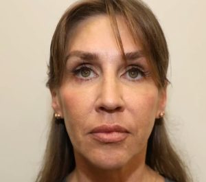 After 2 months Sofwave face treatment at Ava MD