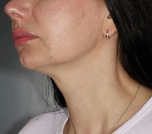 After 2 months Sofwave submental procedure at Dermatology Circle PLLC