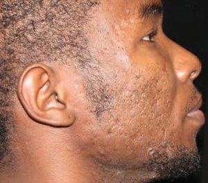 After 2 treatments Sofwave acne scars treatment by Dr. David Goldberg