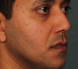 After 3 months Sofwave acne scars treatment by Dr. Arielle Kauvar