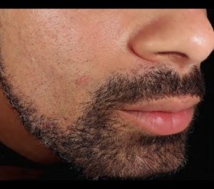 After 3 months Sofwave acne scars treatment by Dr. David Goldberg