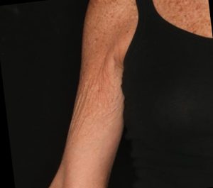 After 3 months Sofwave arms treatment by Dr. Roy Geronemus