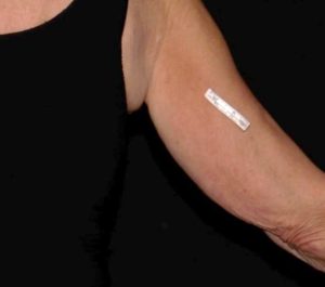 After 3 months Sofwave arms treatment by Amy Taub