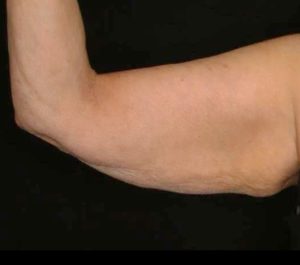 After 3 months Sofwave arms treatment by Dr. Roy Geronemus