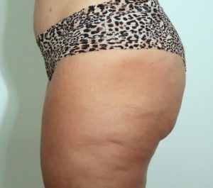 After 3 months Sofwave cellulite treatment by Whitfield