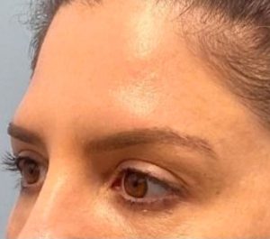 After 3 months Sofwave eyes treatment by Dr. Jason Bloom