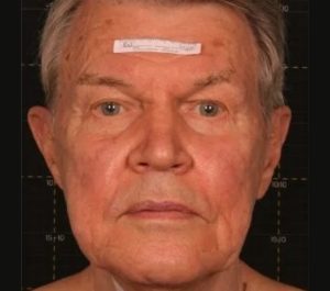 After 3 months Sofwave face treatment by Dr. Roy Geronemus