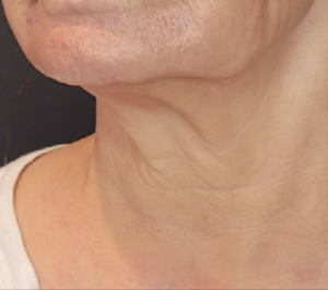 After 3 months Sofwave neck procedure at Smile & Skin Aesthetics