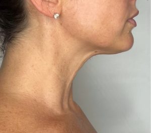 After 3 months Sofwave submental procedure at Laurel Corinne Medspa