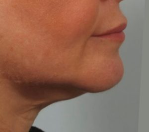 After 3 months Sofwave submental procedure at SKIN I.D Aesthetics