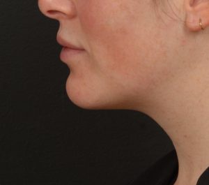 After 3 months Sofwave submental procedure by Sue Ellen Cox