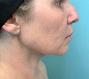 After 3 months Sofwave submental treatment by Weldy Tina