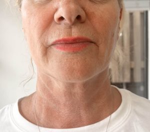 After 4 months Sofwave neck procedure at Skintellect