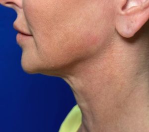 After 4 months Sofwave submental procedure by Adean Kingston