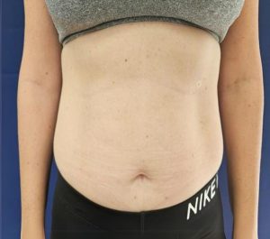 After 4 sessions Sofwave abdominal front view treatment at Sofwave Clinic