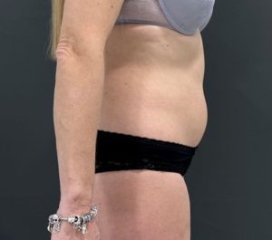 After 4 sessions Sofwave abdominal side view treatment by Virginia Benitez Roig MD