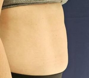 After 4 sessions Sofwave abdominal treatment at Sofwave Clinic