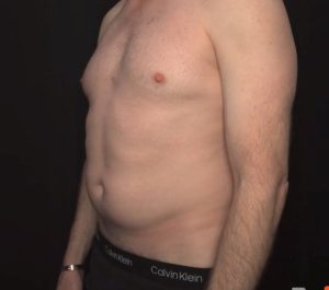 After 4 sessions Sofwave abdominal treatment by Greg Mueller MD