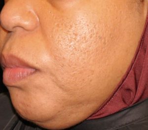 After 4 weeks Sofwave acne scars treatment by Dr. David Goldberg
