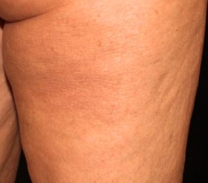 After 4 weeks Sofwave cellulite treatment by Dr. David Goldberg