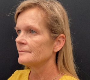 After 5 months Sofwave face treatment at JW's Day Spa