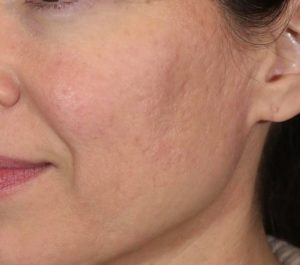 After 6 months Sofwave acne scars treatment by Dr. Anne Chapas