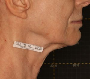 After 6 months Sofwave submental procedure by Dr. Roy Geronemus