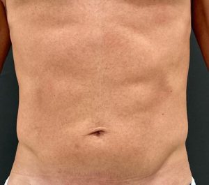 After 6 sessions Sofwave male abdominal front view treatment by Virginia Benitez Roig MD