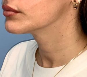 After 6 weeks Sofwave neck procedure at Bloom