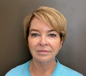 After 7 months Sofwave face treatment at Skinzone Rx