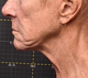 After 9 weeks Sofwave submental procedure by Dr. Munavalli