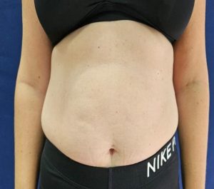 Before Sofwave abdominal front view treatment at Sofwave Clinic