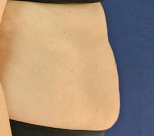 Before Sofwave abdominal treatment at Sofwave Clinic