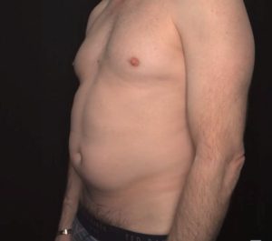 Before Sofwave abdominal treatment by Greg Mueller MD