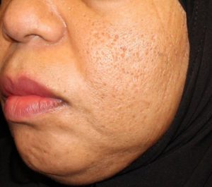 Before Sofwave acne scars treatment by Dr. David Goldberg